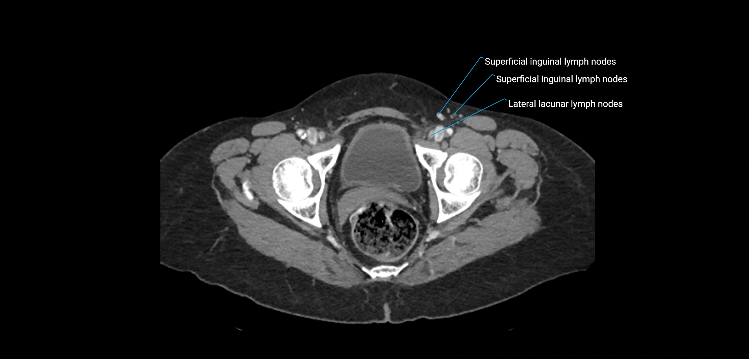 CT ct abdominal lymph nodes  axial cross sectional anatomy  enchanced radiology image -img-00002-00393.webp